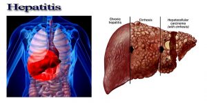 اعراض مرض سرطان الكبد